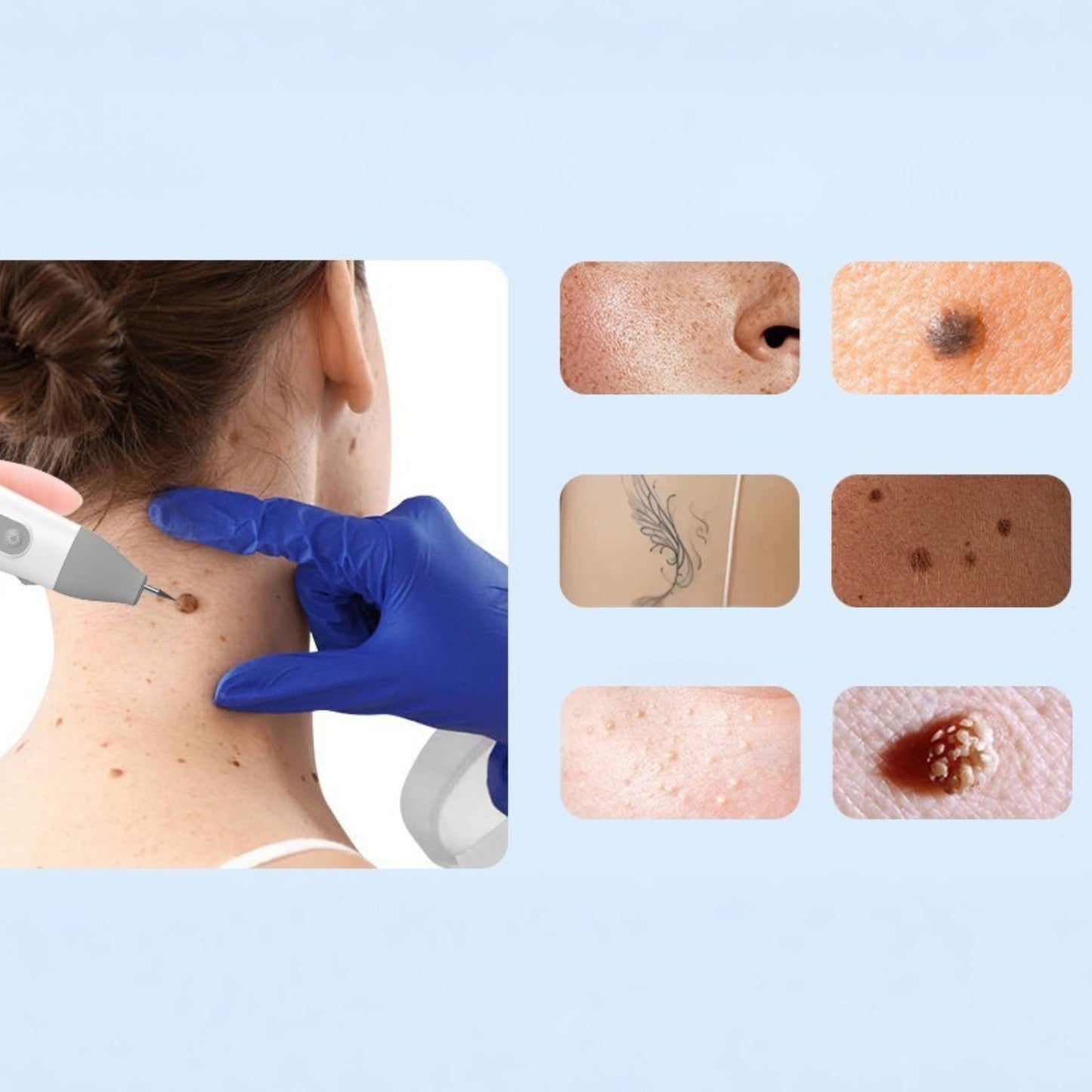 Emprez PLASMA PEN PRO długopis plazmowy do usuwania brodawek i pieprzyków